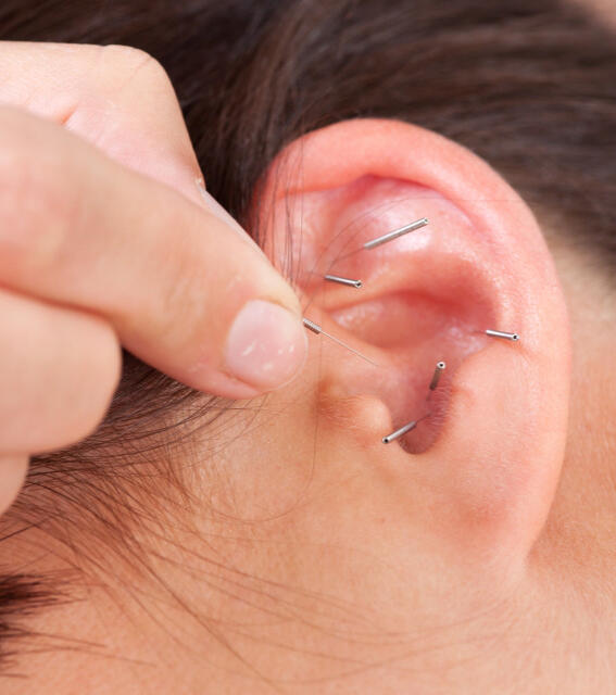 Ear Acupuncture