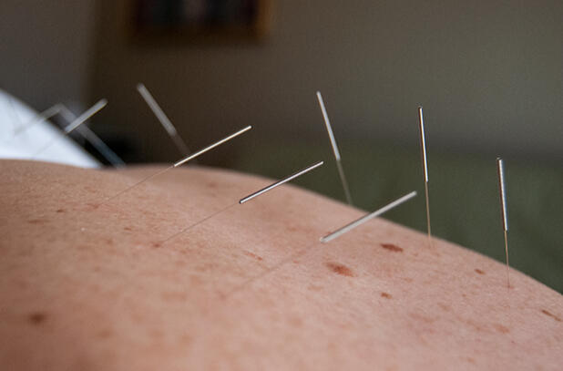 Acupuncture