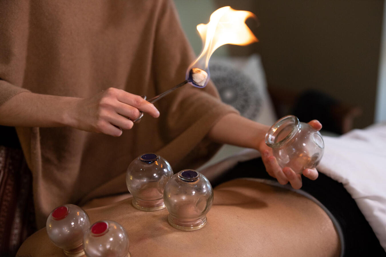 Fire Cupping